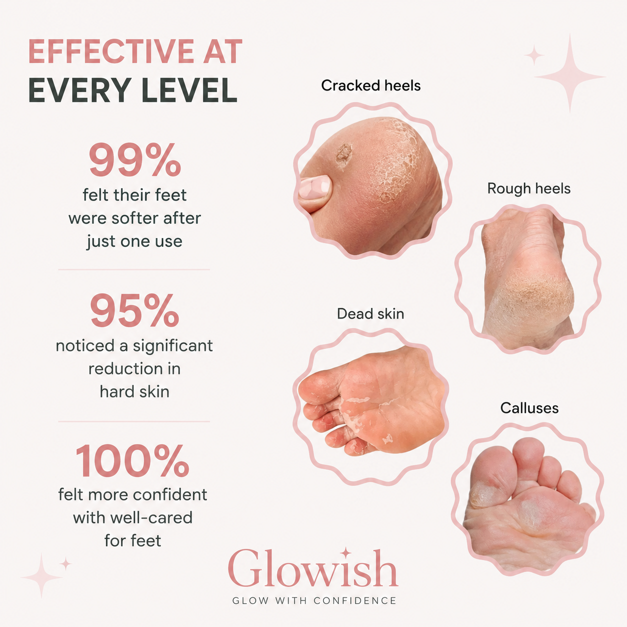 Glowish™ - Electric Callus Remover